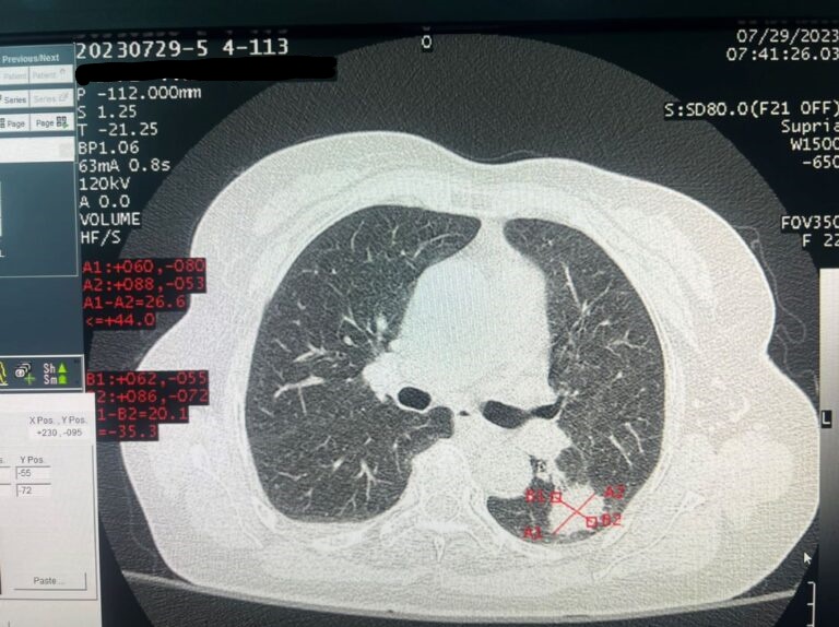 Phim chụp phát hiện khối u phổi