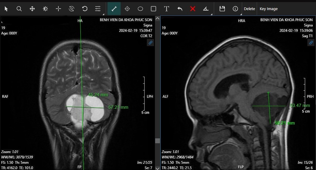 Bệnh nhi 12 tuổi đi khám phát hiện u não